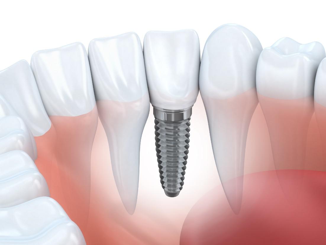Dental Implants West Covina